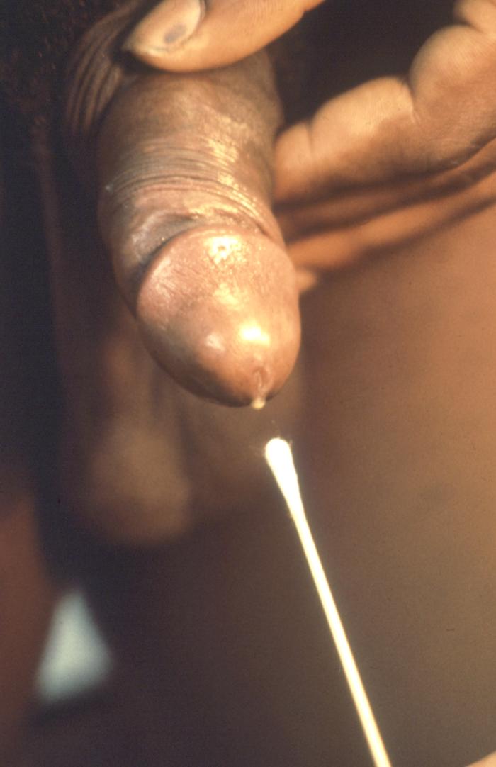 Here a technician is about to collect an intraurethral specimen to be tested for gonorrhea, or non-specific urethritis. Doctors or other health care workers usually use three laboratory techniques to diagnose gonorrhea: staining samples directly for the bacterium, detection of bacterial genes or DNA in the urine, and growing the bacteria in laboratory cultures. Adapted from CDC