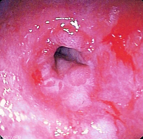 Endoscopic image of peptic stricture, or narrowing of the esophagus near the junction with the stomach due to chronic gastroesophageal reflux. This is the most common cause of dysphagia, or difficulty swallowing, in scleroderma.