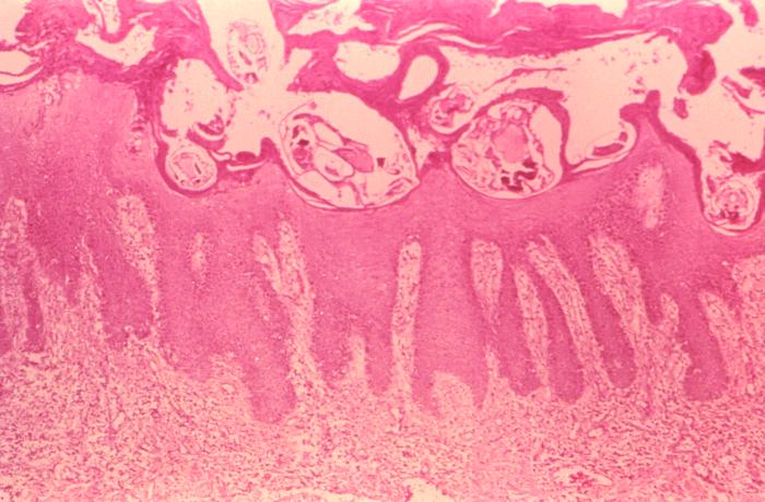 Under a moderate modification, this photomicrograph revealed the histopathologic changes in a human skin sample from the site of a number of scabies burrows, due to an infestation of Sarcoptes scabiei var. hominis. Note that the scabies had burrowed into the upper layers of this patient’s skin, into the epidermis, superficial to the stratum basale, also known as the stratum germinativum. The most common signs and symptoms of scabies are intense itching (pruritus), especially at night, and a pimple-like (papular) itchy rash. The itching and rash each may affect much of the body or be limited to common sites such as the wrist, elbow, armpit, webbing between the fingers, nipple, penis, waist, belt-line, and buttocks. The rash also can include tiny blisters (vesicles) and scales. Scratching the rash can cause skin sores; sometimes these sores become infected by bacteria. Adapted from CDC