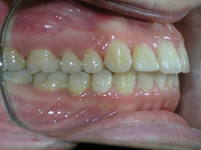 After Orthodontic treatment (Lateral view)