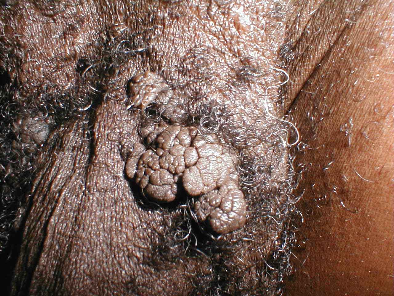 Extensive Penile Condyloma Acuminata