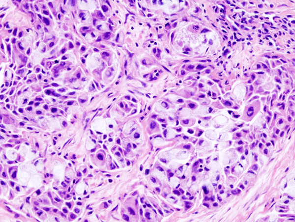 Histopathologic image of mucoepidermoid carcinoma of the major salivary gland.[1]