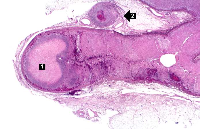 File:Polyarteritis nodosa. a case example 9.jpg