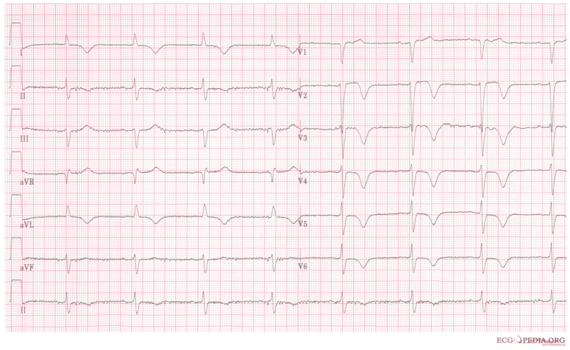 Typical negative T waves post anterior myocardial infarction. This patient also shows QTc prolongation. Whether this has an effect on prognosis is debated. [14] [15] [16]
