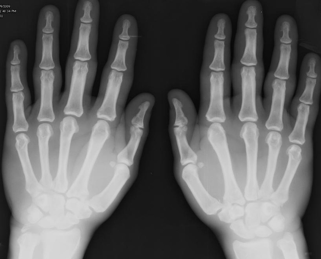 AP radiograph of the hand shows ungal tufting, widening of the bases of distal phalanges, metacarpal osteophytes on radial aspect (metacarpal hooks) and soft tissue hypertrophy. Source: Dr Henry Knipe, <a href="https://radiopaedia.org/">Radiopaedia.org</a>. From the case <a href="https://radiopaedia.org/cases/5743">rID: 5743</a>