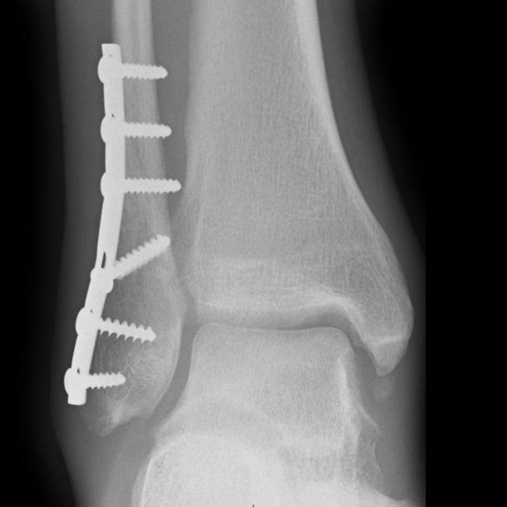 Plate and screw internal fixation of distal fibular fracture. Lateral talar shift has been reduced with reduction of the fibula - distal syndesmosis must have been obviously stable at surgery and thus no diastasis screw was used.