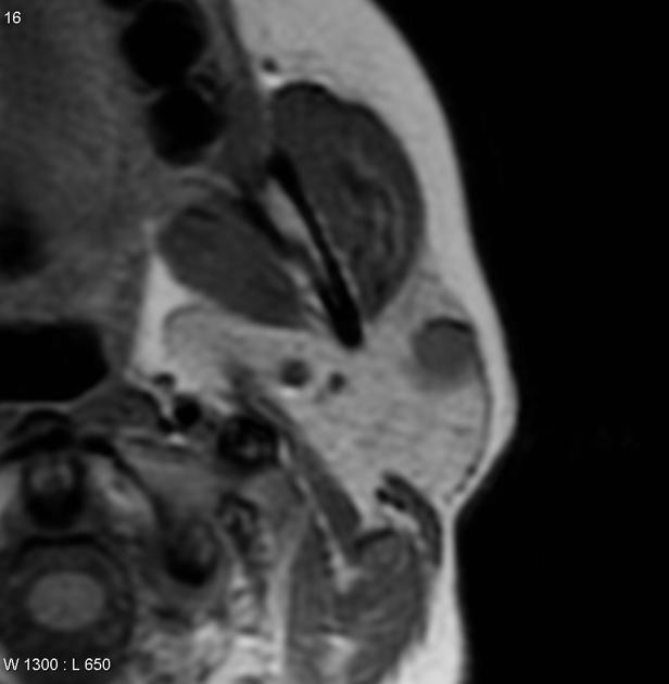 MRI showing Axial T1 parotid adenocarcinoma[5]