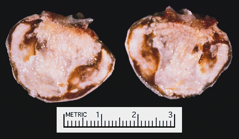 Atrial Myxoma: A calcified right atrial mass on the X ray of a 47-year-old man. Resection demonstrated a smooth-surfaced tumor. The gritty material seen microscopically on cut section was calcified and ossified myxoma.