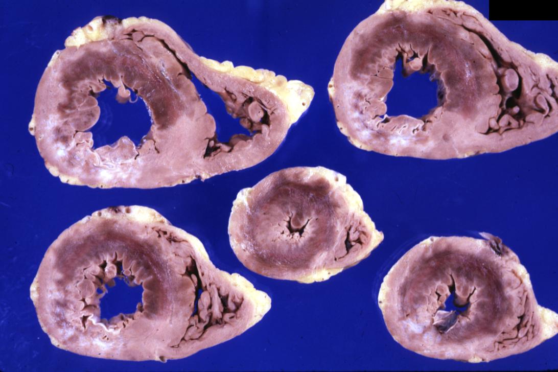 Gross example of acute infarction in fixed heart. Lesion is reflow necrosis stone heart also has old scar. Multisliced view.