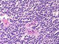 Adrenal neuroblastoma[12]