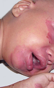 File:Acrodermatitis enteropathica 06.png