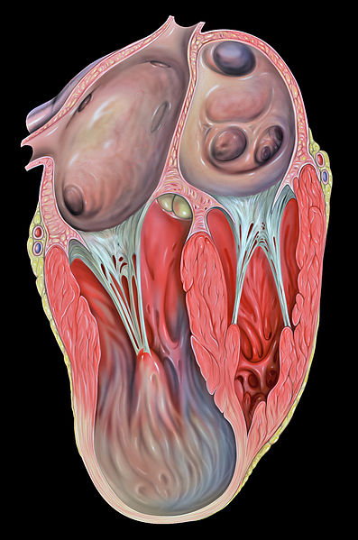 Left ventricular aneurysm.