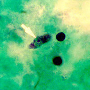 Trophozoite of N. fowleri in CSF, stained with trichrome. Image courtesy of the Texas State Health Department. Adapted from CDC