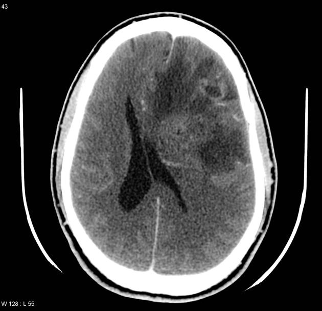File:Oligoastrocytoma contrast CT.jpg