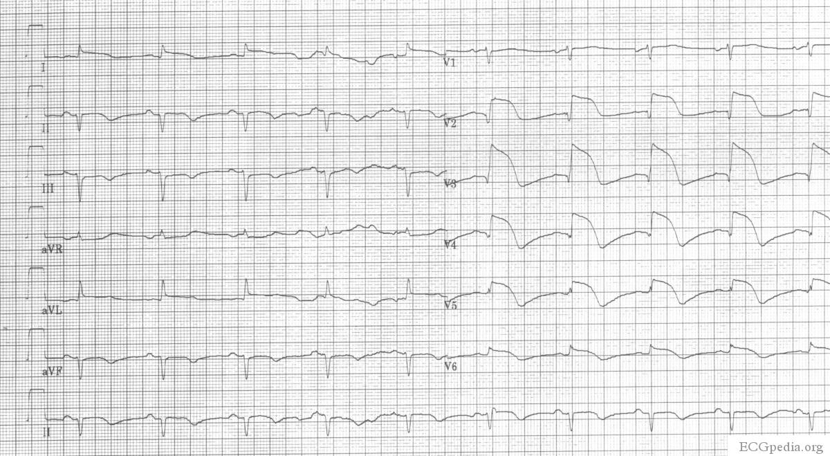A 2 weeks old anterior infarction with Q waves in V2-V4 and persisting ST elevation, a sign of left ventricular aneurysm formation.