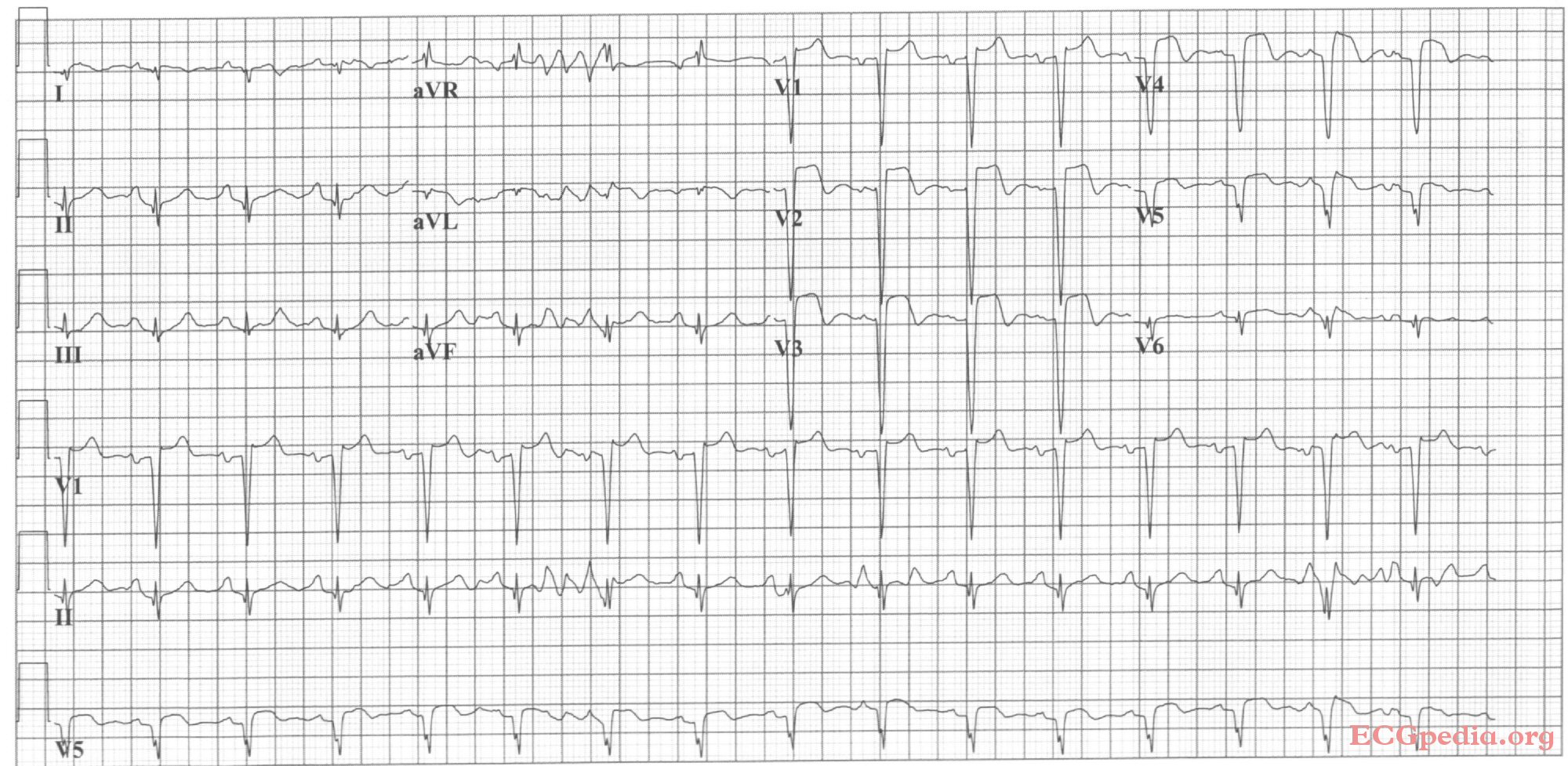 Acute anterior MI. Loss of R waves throughout the anterior wall (V1-V6). QS complexes in V3-V5. ST elevation in V1-V5 with terminal negative T waves.