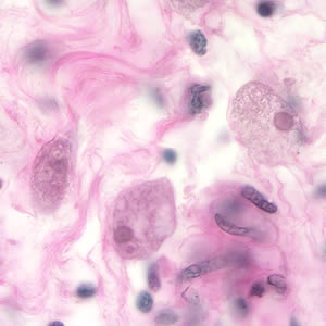 Entamoeba histolytica trophozoites in colon tissue stained with H&E. Adapted from CDC