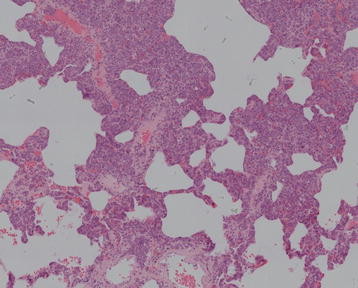Hematoxylin-eosin staining of pulmonary interstitium intravascular lymphoma (100X).[2]