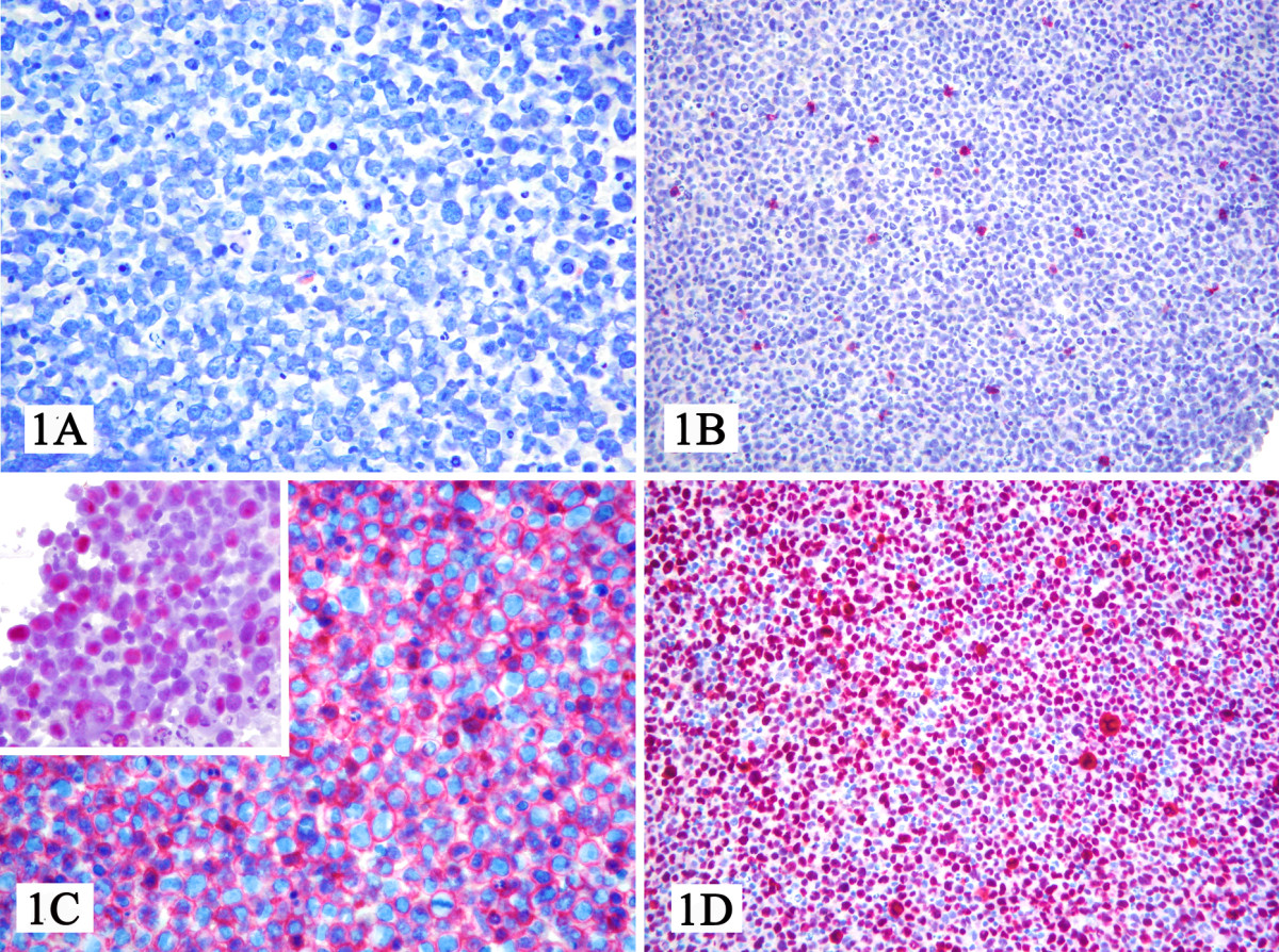 At light microscopy, the sample consisted of a frankly neoplastic population provided with plasmablastic and/or anaplastic morphology (Figure 1A), which turned out CD3-, CD20- (Figure 1B), CD79a-, CD45+ (Figure 1C), CD38+, CD30+, IRF4+, LANA-1+ (Figure 1D), EBER+ (Figure 1C inset), and Ki-67>90%. Based on these findings, we made a diagnosis of Primary effusion lymphoma.[2]