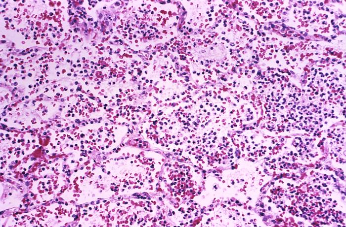 Photomicrograph depicting the histopathologic changes in lung tissue in a case of fatal human plague pneumonia; Mag. 160X Adapted from Public Health Image Library (PHIL), Centers for Disease Control and Prevention.[15]