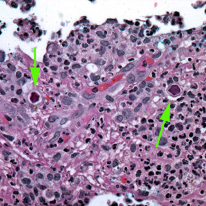 Cysts of Acanthamoeba sp. (green arrows) in tissue, stained with H&E. Adapted from CDC