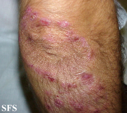 Dermatitis herpetiformis. Adapted from Dermatology Atlas.[14]