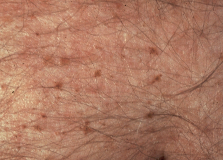 Fig.2 Pubic lice in abdomen