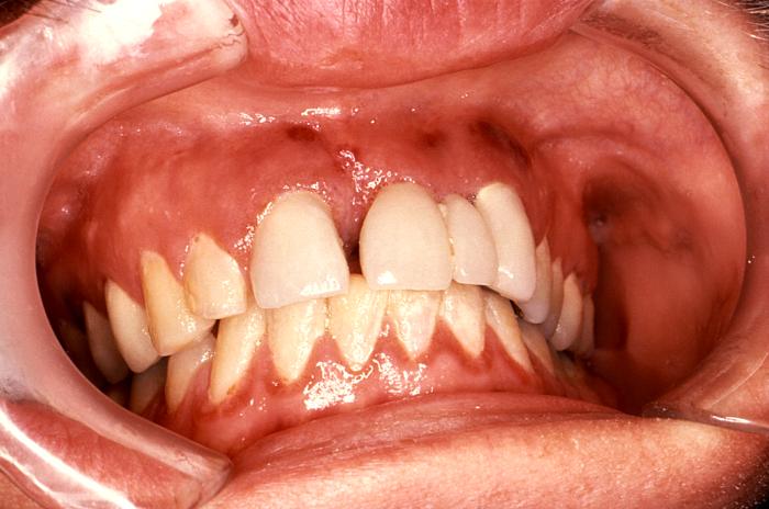 Labial and gingival Kaposi’s sarcoma. From Public Health Image Library (PHIL). [3]