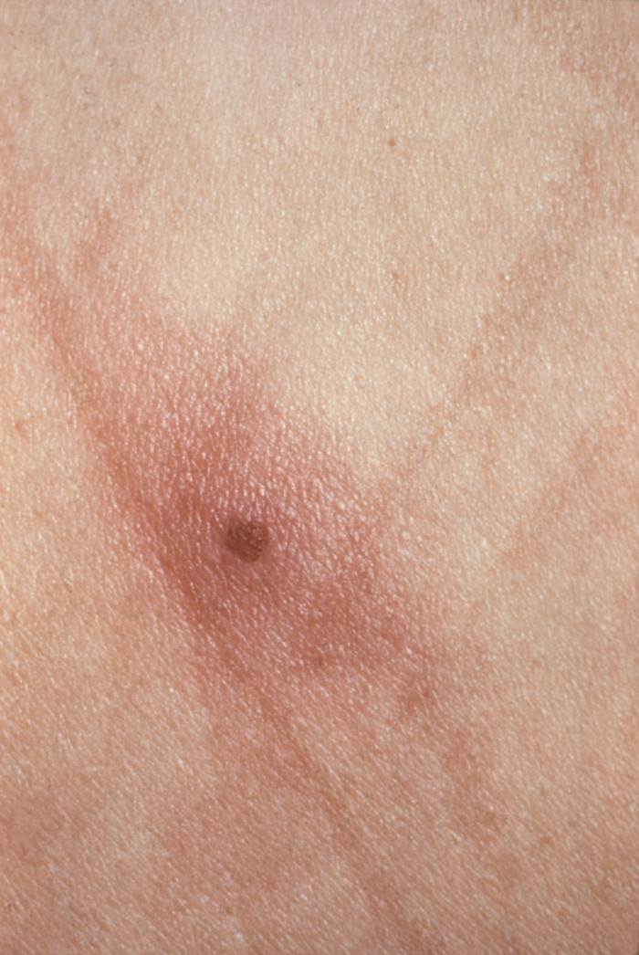 This was a skin lesion on a patient with gonorrhea due to the systemic spread of N. gonorrhoeae bacteria. Gonorrhea is caused by Neisseria gonorrhoeae. If left untreated, will enter the blood, thereby, spreading throughout the body. As is shown here, such full body dissemination may manifest itself as skin lesions throughout the body. Adapted from CDC