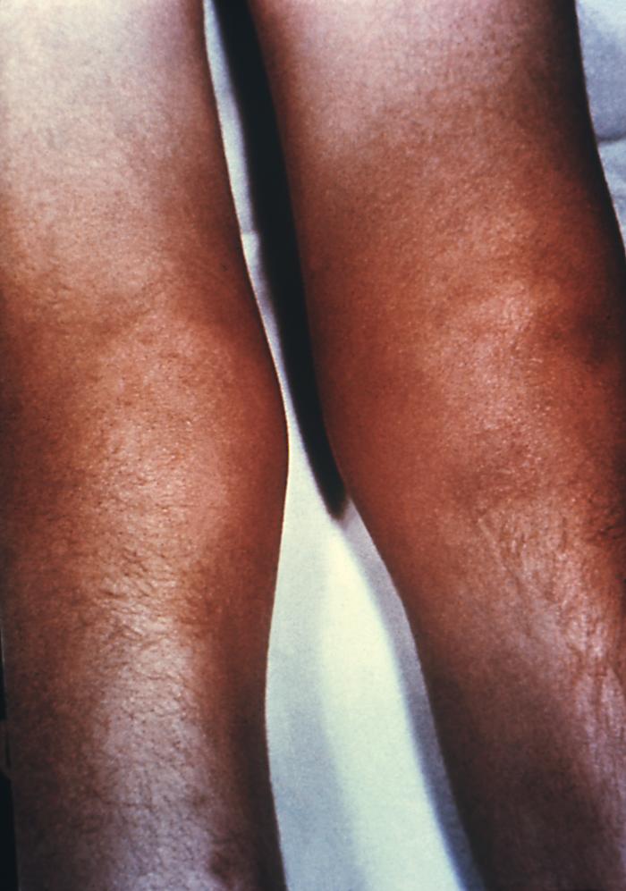 A photograph depicts an anterior view of a patient's knees, who'd been diagnosed with "Clutton’s joints" due to what was determined to be congenital syphilis. See PHIL 12598, for a view of the patient's right knee, from a lateral perspective. ”Clutton's joints”, or symmetrical hydrarthrosis of the knee joints, is a painless condition that often occurs during the late stages of congenital syphilis. It involves synovitis, or swelling of a joint, accompanied by collections of fluid within the joint capsule. Adapted from CDC