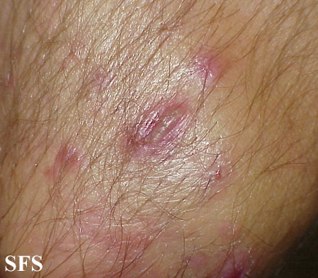 File:Dermatitis herpetiformis22.jpg