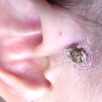 Infected pre-auricular cyst in a child. This was treated with antibiotics and excised at a later date.[4]