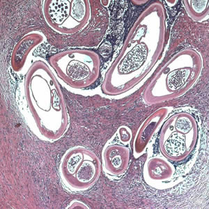 Adult of O. volvulus in a subcutaneous nodule, stained with hematoxylin and eosin (H&E). Adapted from CDC