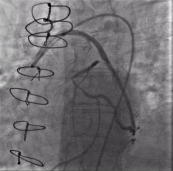 Video 1. Injection of SVG to OM graft with retrograde filling of the entire circumflex system which then provides antegrade flow into the LAD. Stenosis seen both in the proximal circumflex and ostial LAD.