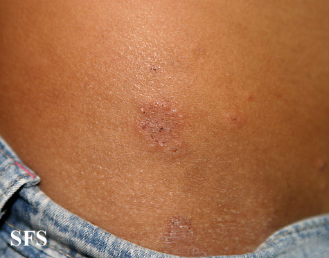 Dermatitis herpetiformis. Adapted from Dermatology Atlas.[1]