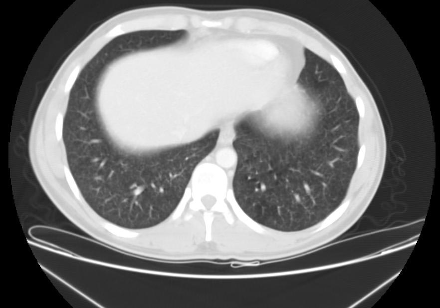 Miliary tuberculosis CT - wikidoc