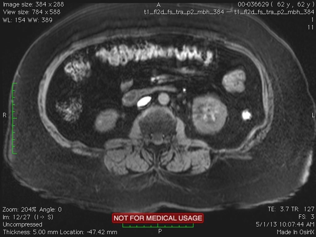 File:Renal-cell-carcinoma-on-mri(1).jpg