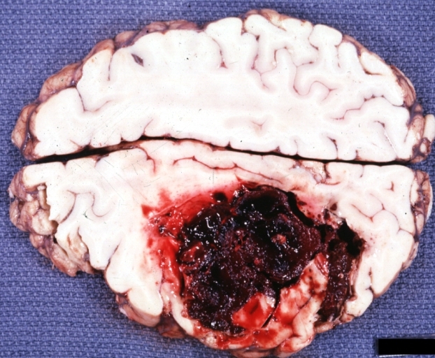 Brain: Hemorrhage Massive With Lupus Erythematosus: Gross natural color but not best exposure large left frontoparietal hemorrhage in 16yo female with advanced lupus nephritis and sepsis