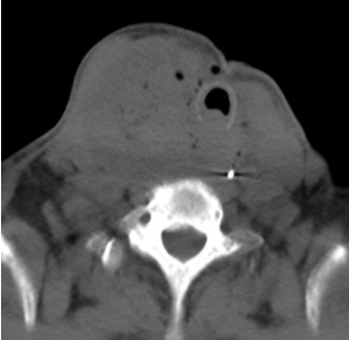 File:CT Anaplastic thyroid cancer.png