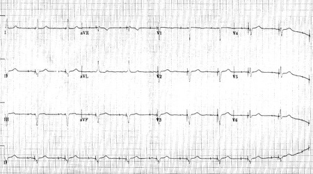 12 lead EKG: Dual chamber pacemaker