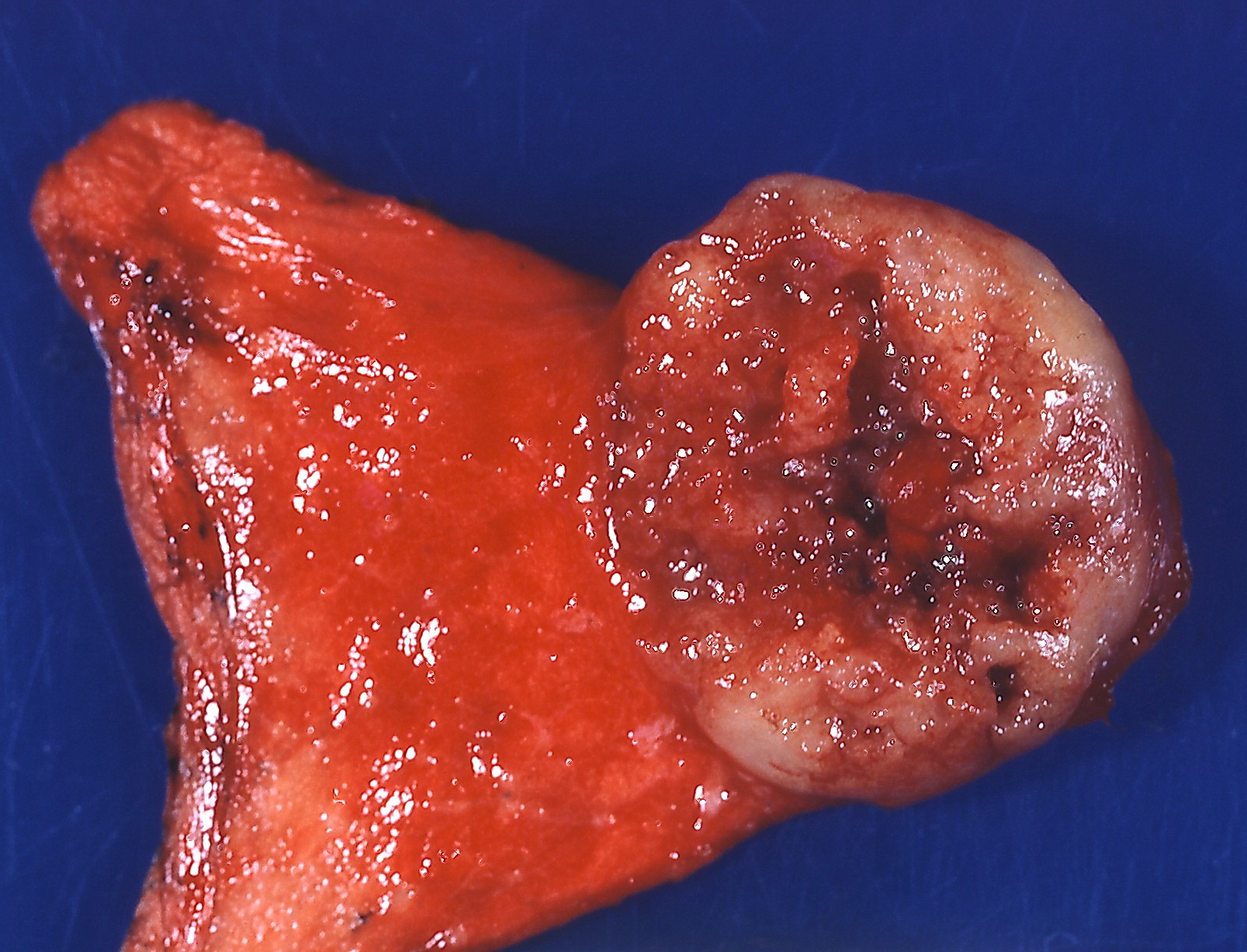 Gross pathology mucoepidermoid carcinoma.[17]