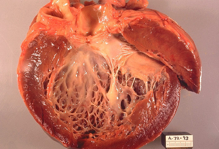 cardiomyopathy disease