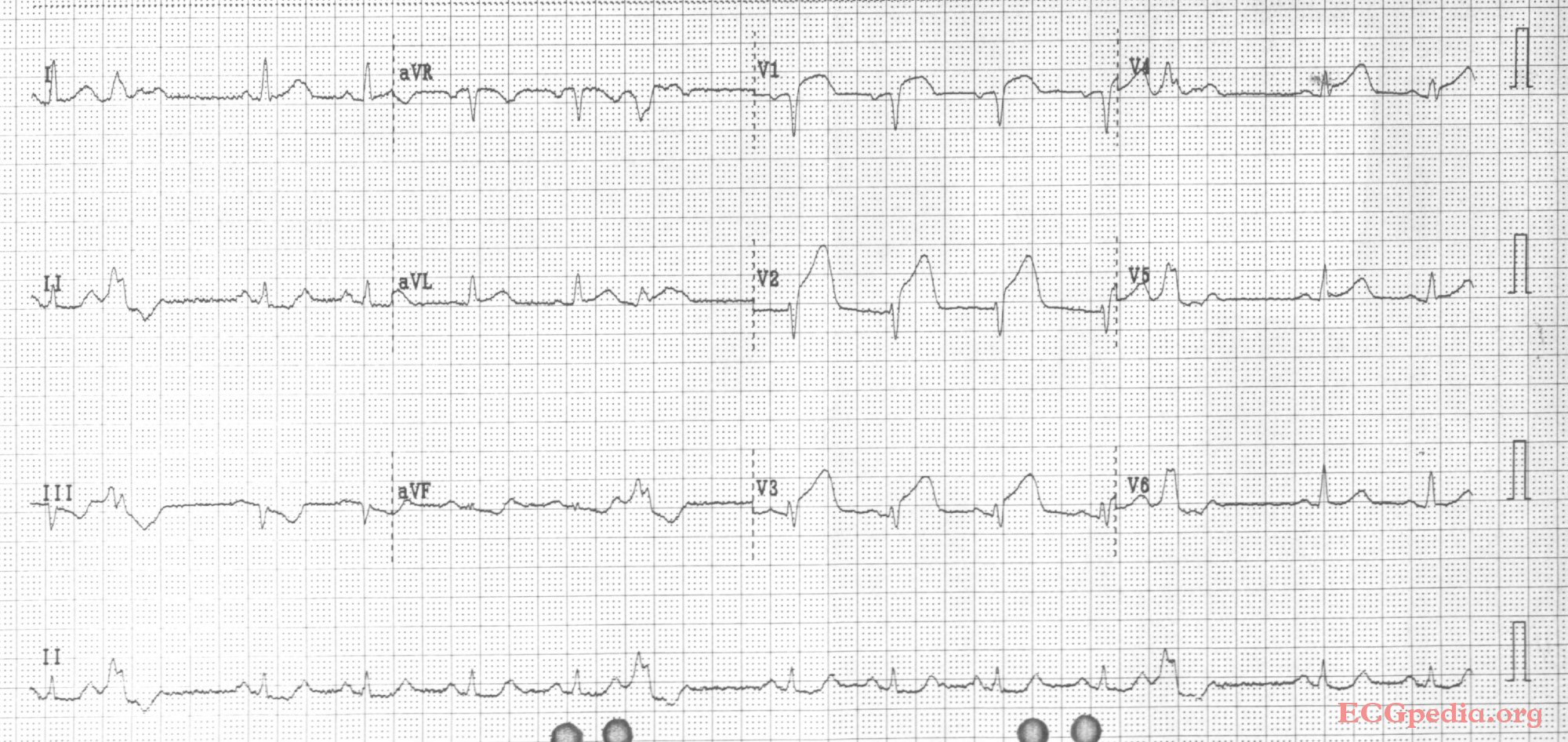 Acute MI with proximal LAD occlusion