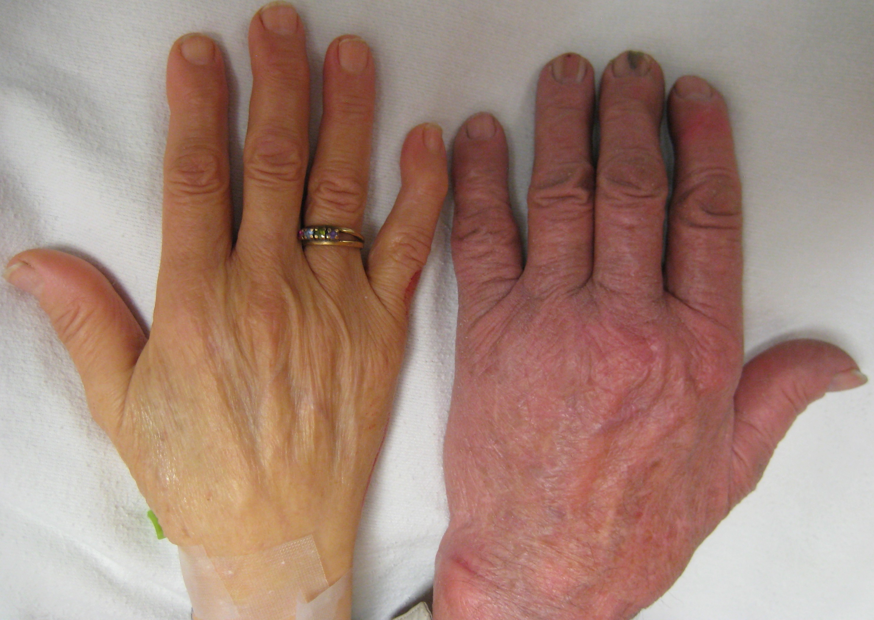 The hand of a person with severe anemia (on the left) compared to one without (on the right) Source -James Heilman, MD - Own work[4]