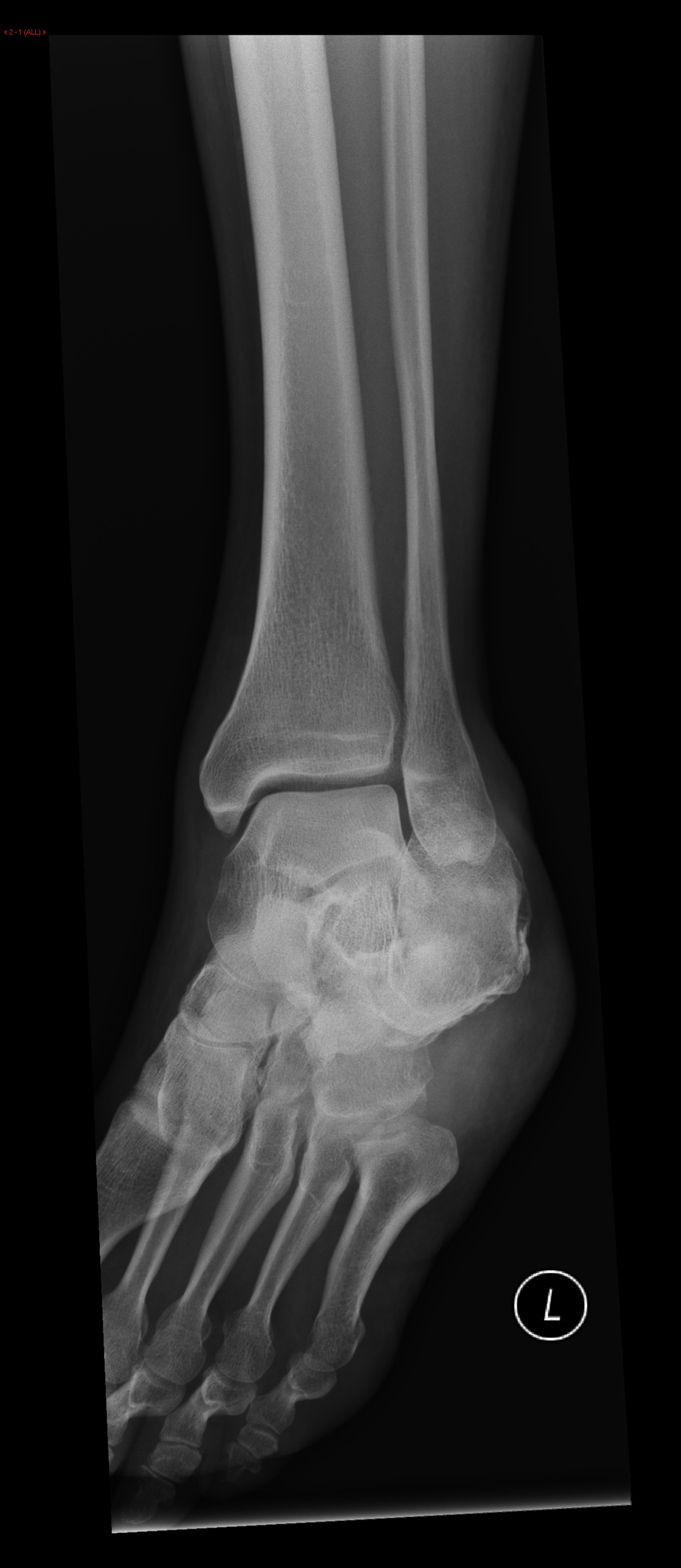 File:Calcaneal-fracture-and-associated-spinal-injury (3).jpg