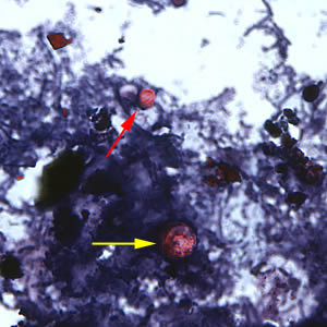 Oocyst of C. cayetanensis (yellow arrow) along with an oocyst of Cryptosporidium parvum (red arrow), stained with safranin (SAF). Cryptosporidium spp. also stain with the safranin and modified acid-fast stains. Adapted from CDC