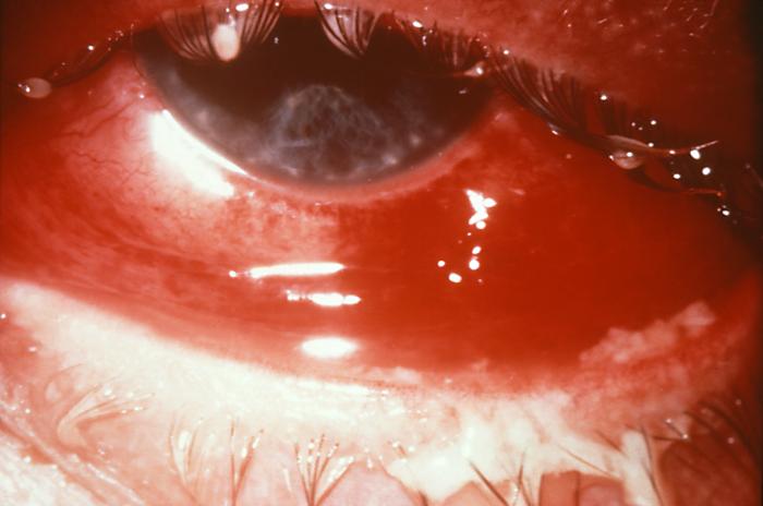This case of gonorrheal conjunctivitis resulted in partial blindness due to the spread of N. gonorrhoeae bacteria. Gonococci cause both localized infections, usually in the genital tract, and disseminated infections with seeding of various organs. Diagnosis of localized infections depends on Gram-staining, and culture of the discharge. Adapted from CDC