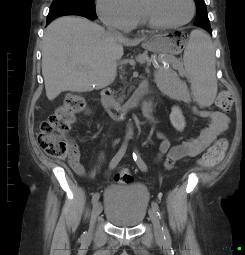 File:Acure-renal-failure-post-iv-contrast-injection-ct-findings.jpg