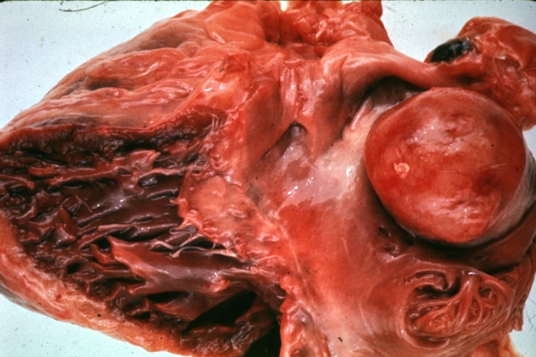 HEART: Metastatic Tumor: Gross very unusual large metastatic carcinoid in right atrium
