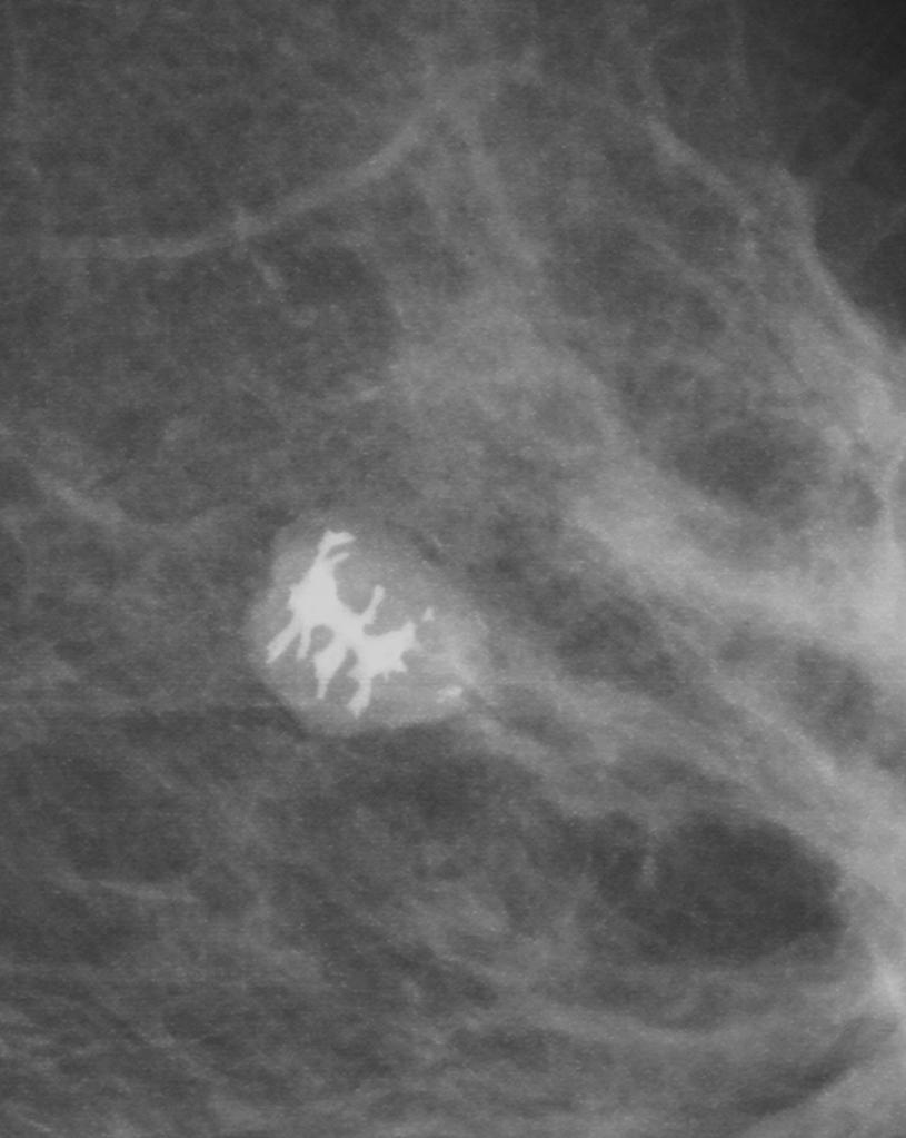 File:Fibroadenoma mammogram 1.jpg